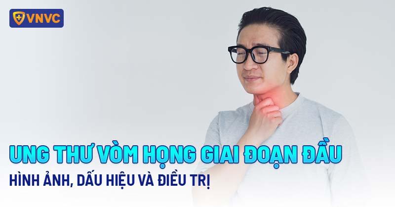 ung thư vòm họng giai đoạn 2