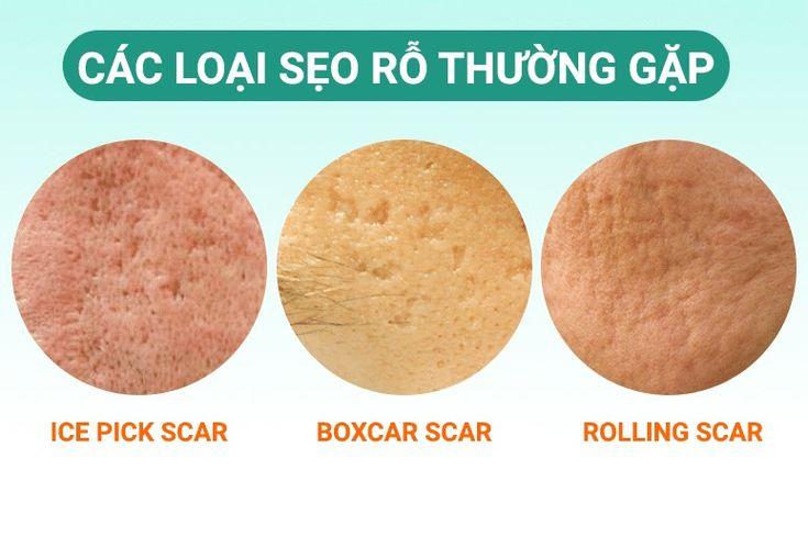 sẹo lõm