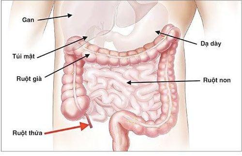 Vị trí thường thấy của ruột thừa.
