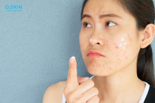 Top 12 thuốc trị sẹo thâm hiệu quả được bác sĩ đánh giá cao